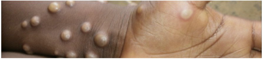 晓平说消毒丨倪晓平：猴痘的预防和控制