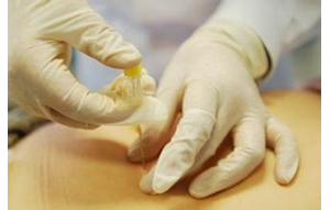 埋线减肥“零感染”秘籍：院感科必盯的6个细节！